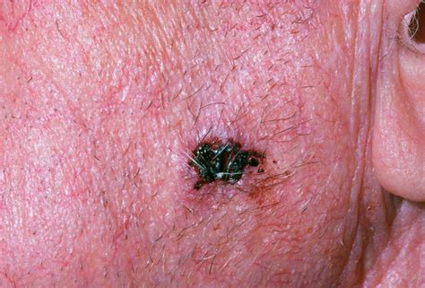 Close Up Showing A Basal Cell Carcinoma On Face Photograph By Dr P