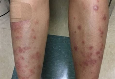 Derm Dx Disseminated Lesions With Fever Chills And Malaise