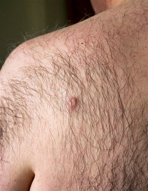 Ask your doctor what method of hair removal will work best. PILONIDAL CYST TREATMENT WITHOUT SURGERY - HOW TO DO IT ...