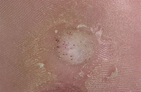 If you are a doctor message mods with proof if you would like a special flair. Plantar Wart Pictures - 20 Photos & Images / illnessee.com
