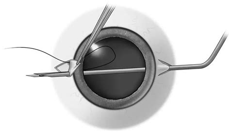 Pars Plana Vitrectomy American Academy Of Ophthalmology