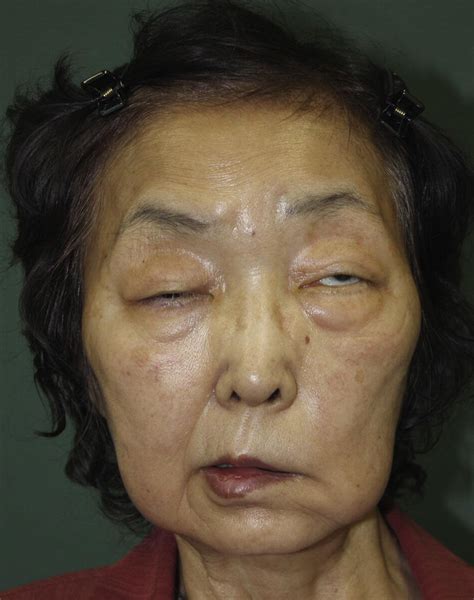 Surgical Treatment Of Severe Blepharoptosis And Facial Palsy Caused By
