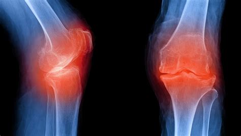 Updated Guidelines For The Management Of Osteoarthritis Released