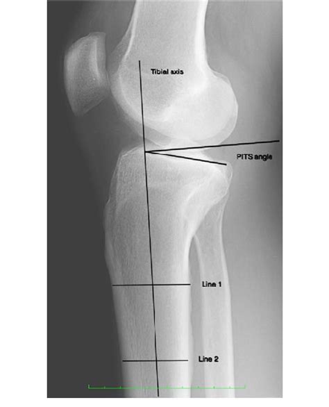 Posterior Inferior Tibial Slope Pits Measurement The Pits Angle Is