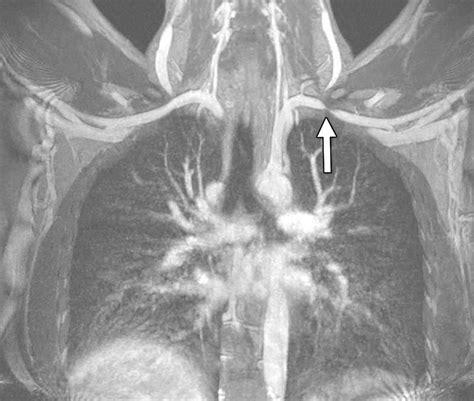 Imaging Of The Patient With Thoracic Outlet Syndrome Radiographics