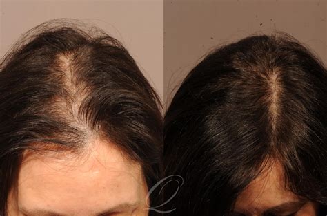 Female Fut Hair Transplant Before And After Photo Gallery Rochester