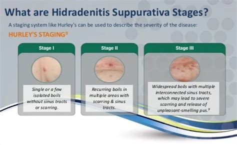 Hidradenitis Suppurativa Hs Hurley Stages Otosection