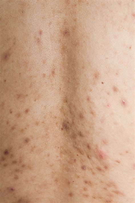 Post Inflammatory Hyperpigmentation And Acne