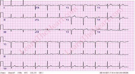 Old Anterior Wall Myocardial Infarction MI ECG Learn The Heart