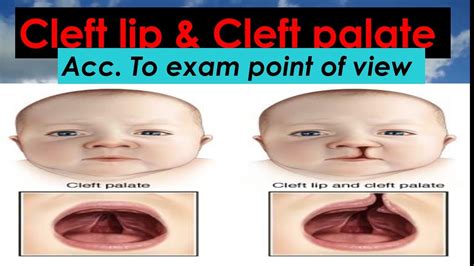 Cleft Lip खण्ड ओष्ठ And Cleft Palate खण्ड तालु In Simple Andeasy Way