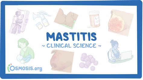 Mastitis Clinical Sciences Osmosis Video Library