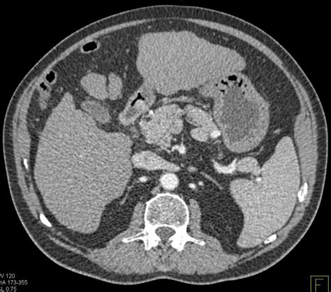 Cirrhosis Of The Liver Liver Case Studies Ctisus Ct Scanning
