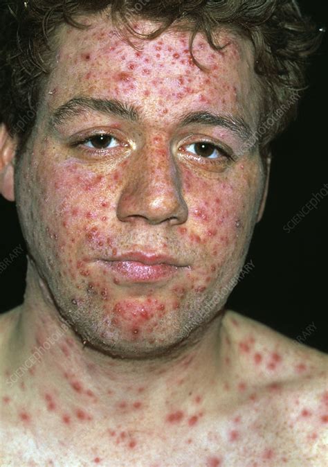 Chickenpox Blisters On Face Stock Image M1300602 Science Photo Library