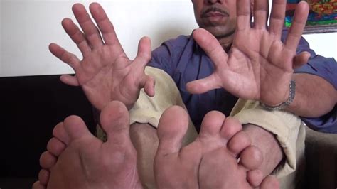 Meet The Indian Carpenter Who Holds The Guinness World Record For Most Fingers And Toes On A