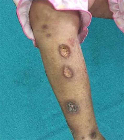 Successful Treatment Of Pyoderma Gangrenosum With Concomitant