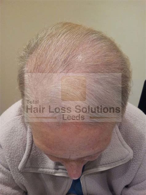 Designed For Results Total Hair Loss Solutions