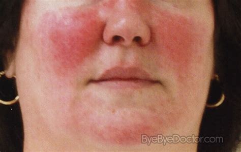 Acne Rosacea Pictures Symptoms Causes Treatment And Prevention Of