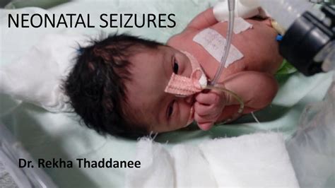 Neonatal Seizures Pediatrics Youtube