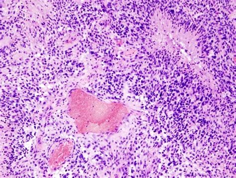 Understanding Glioblastoma The Most Common—and Lethal—form Of Brain Cancer