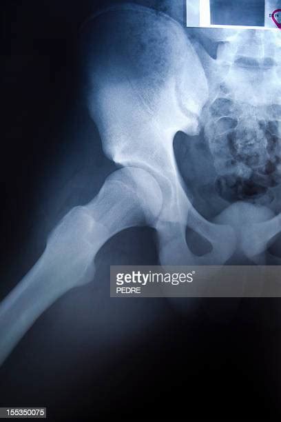 Pelvis Xray Photos And Premium High Res Pictures Getty Images