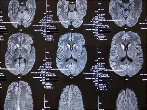 Young Onset Sporadic Creutzfeldtjakob Disease With Atypical Phenotypic
