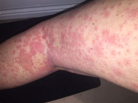 ‘bizarre Rash Leads To Cancer Diagnosis For Young Woman Globalnewsca