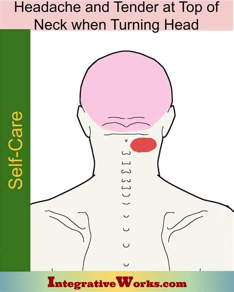 Self Care Headache And Tender At Top Of Neck When Turning Head