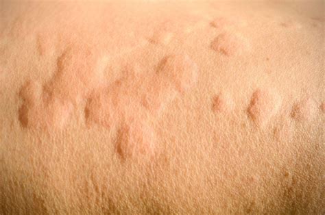 Homeopathy Treatment For Urticaria Sofea Homeopathy Center