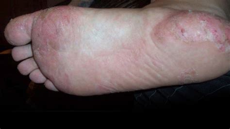 Dyshidrotic Eczema Dorothee Padraig South West Skin Health Care