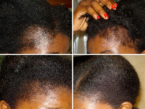 The emu oil comes from the thick pad of fat on an emu's back. Best Organic Emu Oil for Hair Growth | HAIR | Black castor ...