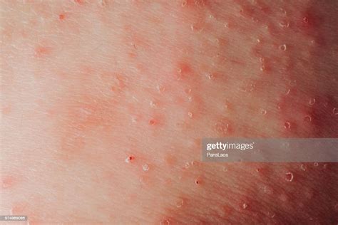 Dermatitis Eczema Texture Of Ill Human Skin Stock Photo Getty Images