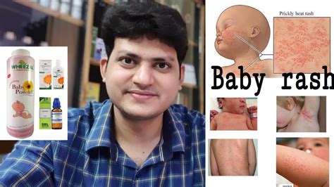 Common Childhood Rashes Homeopathic Medicine For Baby Rashes Baby