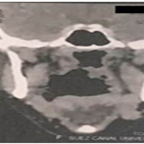 Coronal Ct Showing The Oropharyngeal Defect In The Right Tonsillar Area