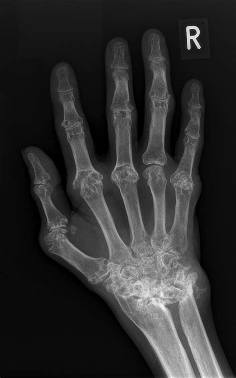 Rheumatoid Arthritis Hand Radiology At St Vincents University