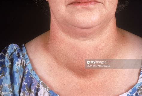 Woman With A Goiter A Goiter Is A Swelling Of The Neck Caused By