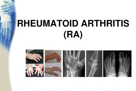 Ppt Rheumatoid Arthritis Ra Powerpoint Presentation Free Download