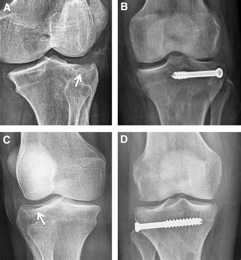 A Fluoroscopy Free Technique For Percutaneous Screw Positioning During