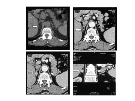 Overview Of Endocrine Hypertension Endotext Ncbi Bookshelf