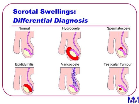 005 Scrotal Swellings Introduction To Clinical Surgery Lectures