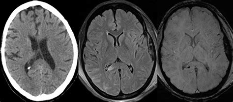 Diffuse Axonal Injury Axial Nonenhanced Ct Scan Showing Subtle