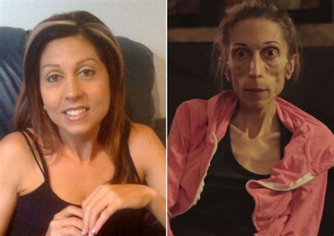 Anorexic Woman Rachael Farrokh Who Weighs Just 40lbs Raises Over 150k For Treatment After