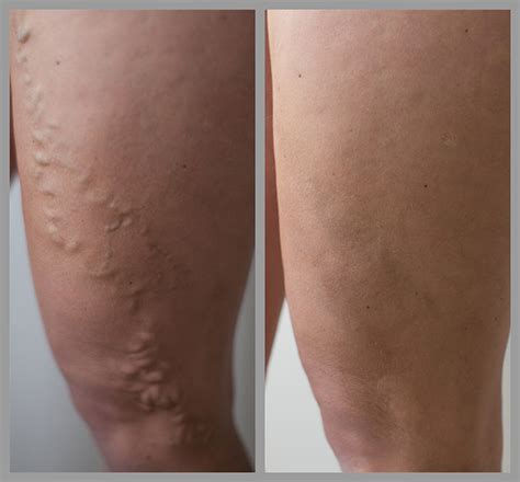 Varicose Vein Treatment Before After Photos Varicose Veins Removal Pictures Veins Clinic UK