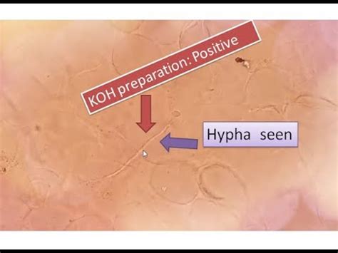 Koh Positive Fungal Elements Seen Sputum Hyphae Youtube