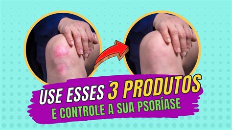 Combo 3 Produtos Que Controlam A Psoríase Descubra Como Tratar A