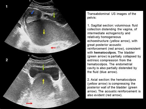 Hematocolpos By Imperforate Hymen Uncommon Cause Of Abdominal Pain