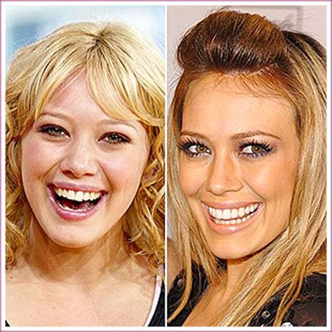 Celebrity Plastic Surgery Before And After 56 Pics