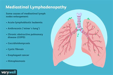 Mediastinal Lymphadenopathy Swollen Lymph Nodes In The Chest