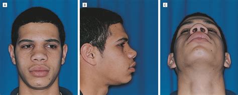 Buchwald c, bonding p, kirkby b, fallentim e (1995) modified midfacial degloving. Maxillary Removal and Reinsertion in Pediatric Patients ...