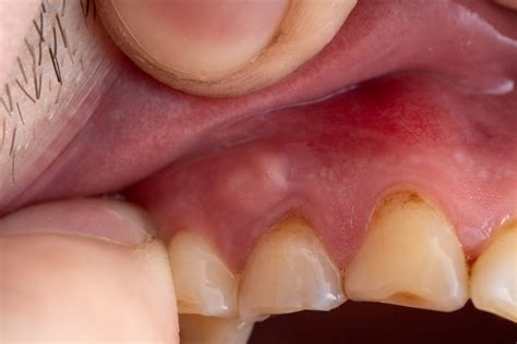 Doylestown Dental Abscess Infection 24 7 Emergency Care