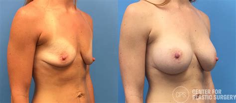 Breast Augmentation Before After Photos Patient Chevy Chase